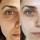 RevitalEyes™ Fortschrittliche Regenerationstherapie unter den Augen